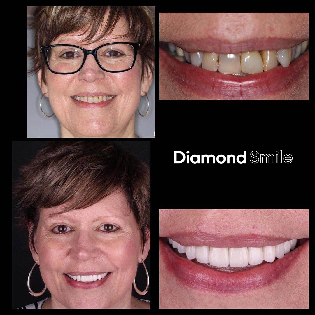 diamondsmile-premium-zahnbleaching-set-mit-gel-und-led image 8