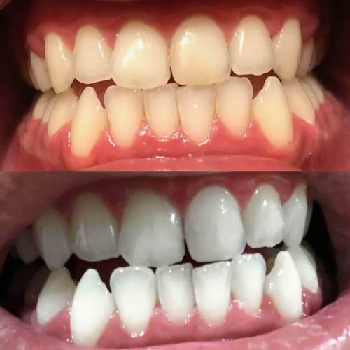 diamondsmile-black-aktivkohle-zahnbleaching-strips-zahnaufhellungsstreifen image 8