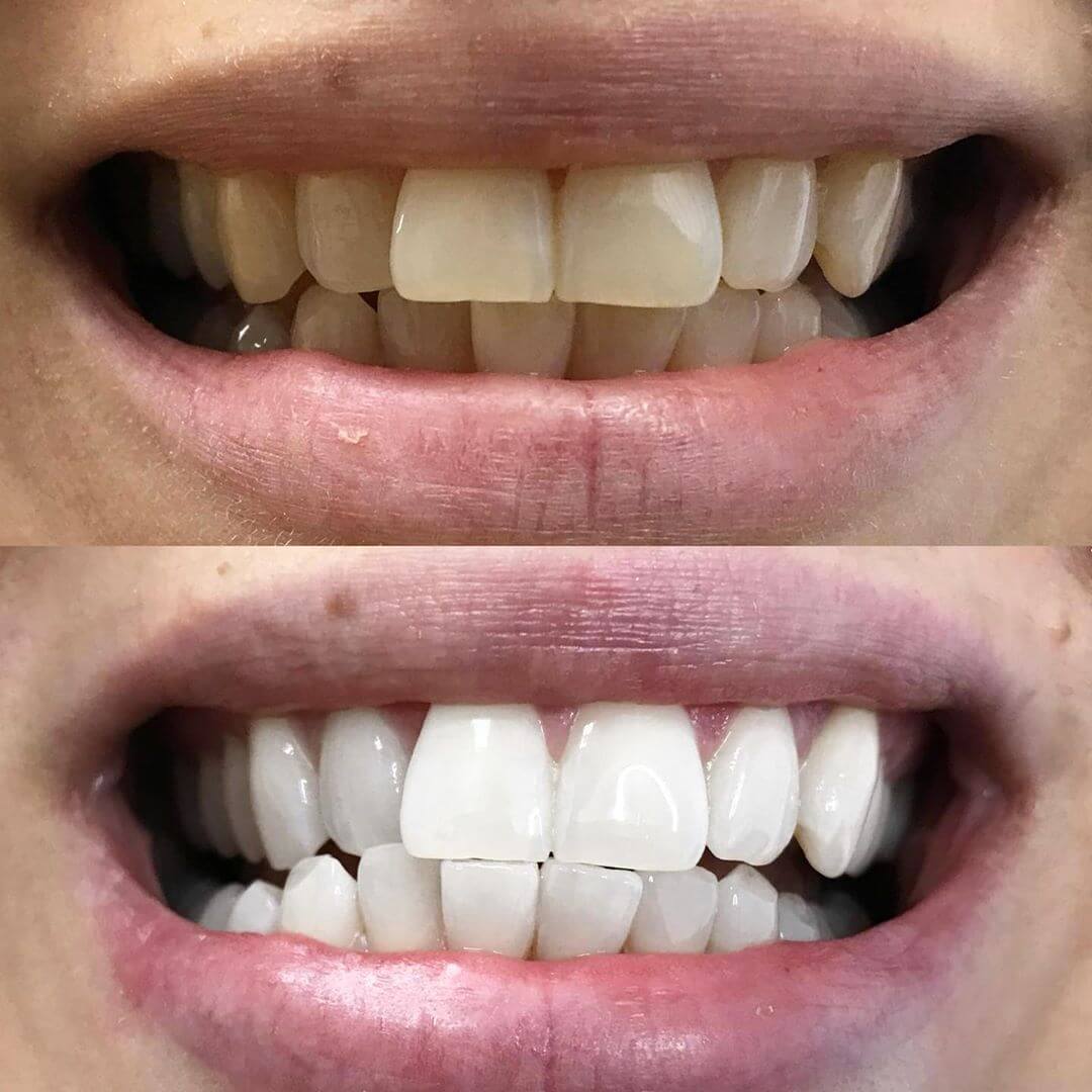 diamondsmile-zahnbleaching-stift-whitening-pen-f-r-unterwegs-mit-sofort-effekt image 7
