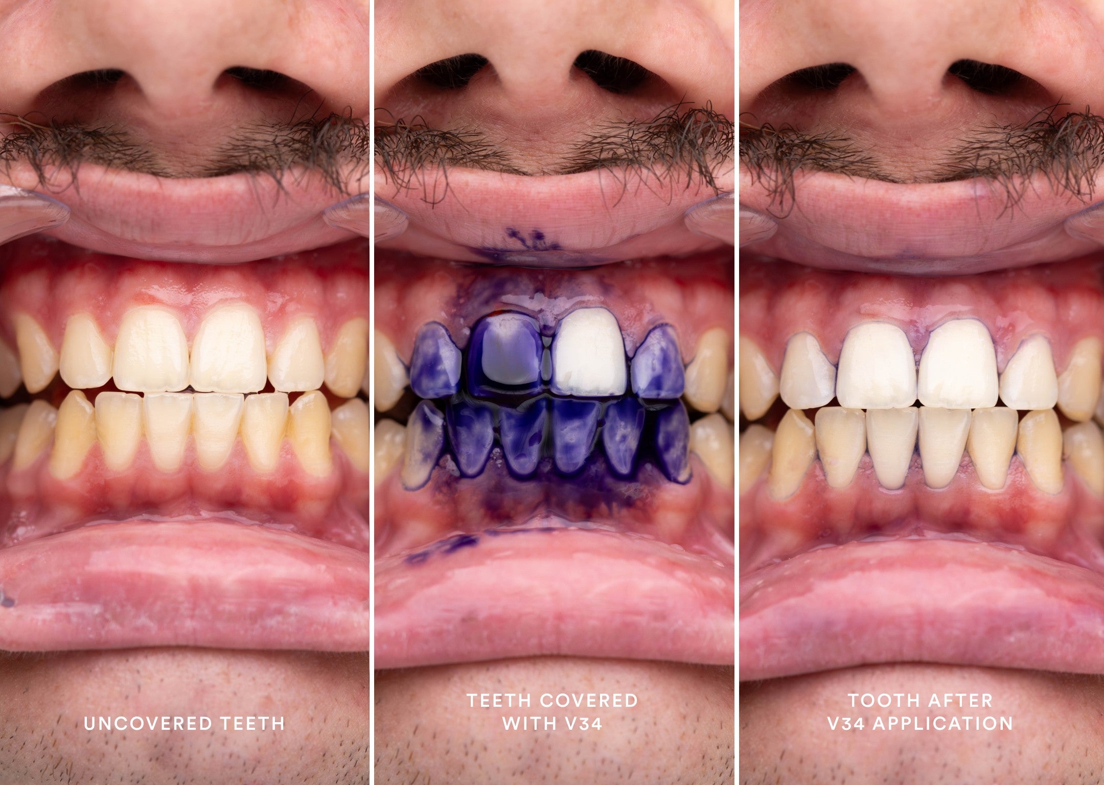 hismile-v34-colour-corrector-serum-lila-farbkorrektur-f-r-wei-eren-look image 5