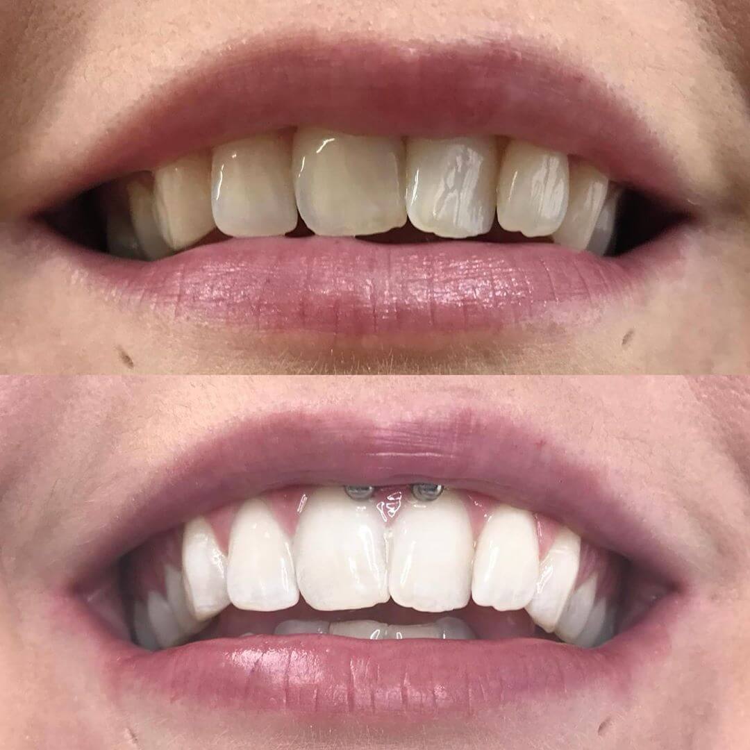 diamondsmile-zahnbleaching-stift-whitening-pen-f-r-unterwegs-mit-sofort-effekt image 8