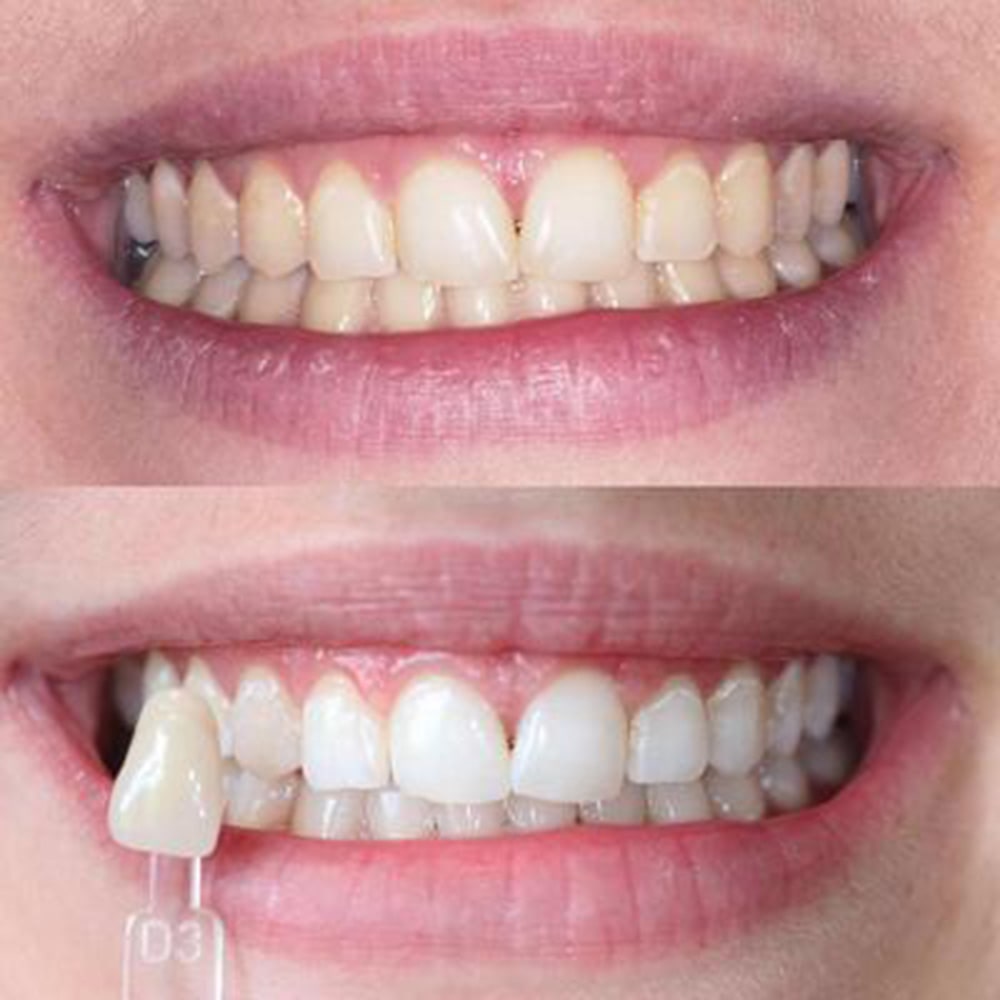 diamondsmile-farbkorrektur-zahnbleaching-gel-lila image 7