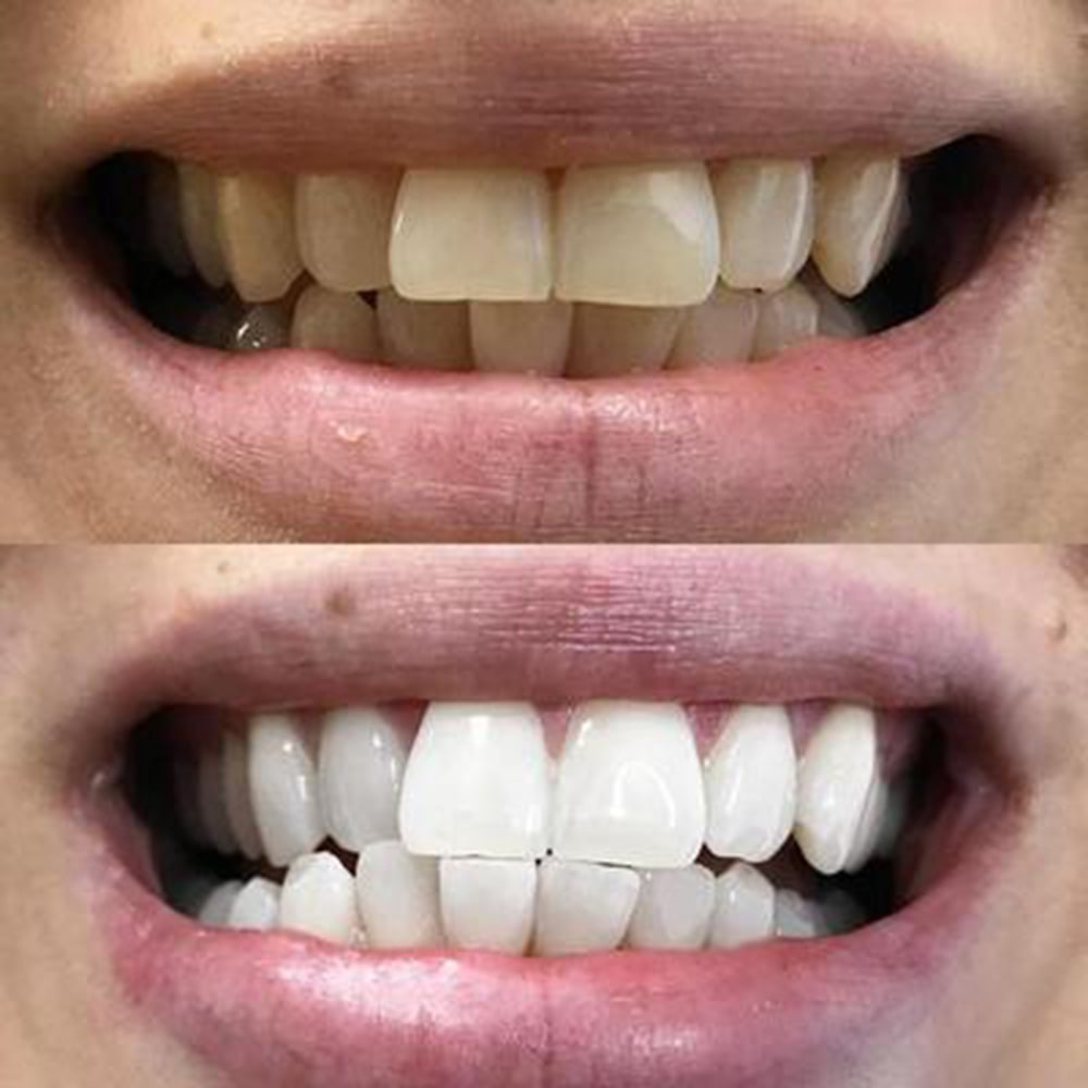 diamondsmile-zahnbleaching-schaum-zur-zahnaufhellung-zu-hause image 7