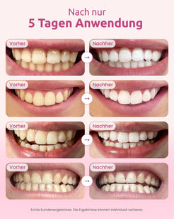 onlysmile-zahnbleaching-set-mit-led-whitening-studio-f-r-zu-hause image 4