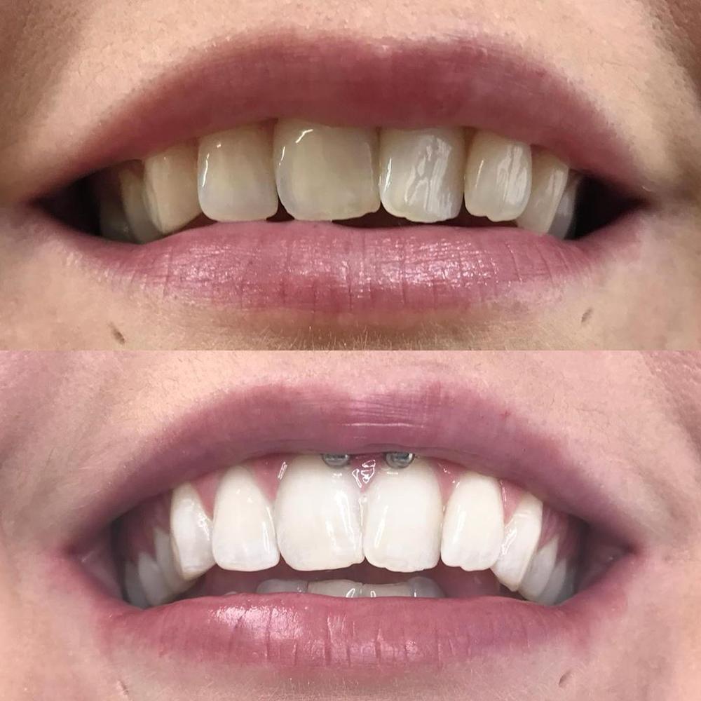 diamondsmile-zahnbleaching-farbkorrektur-serum image 8