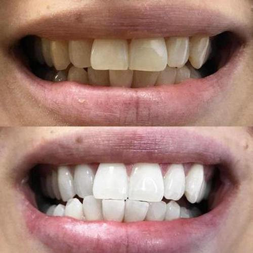 diamondsmile-black-aktivkohle-zahnbleaching-strips-zahnaufhellungsstreifen image 5