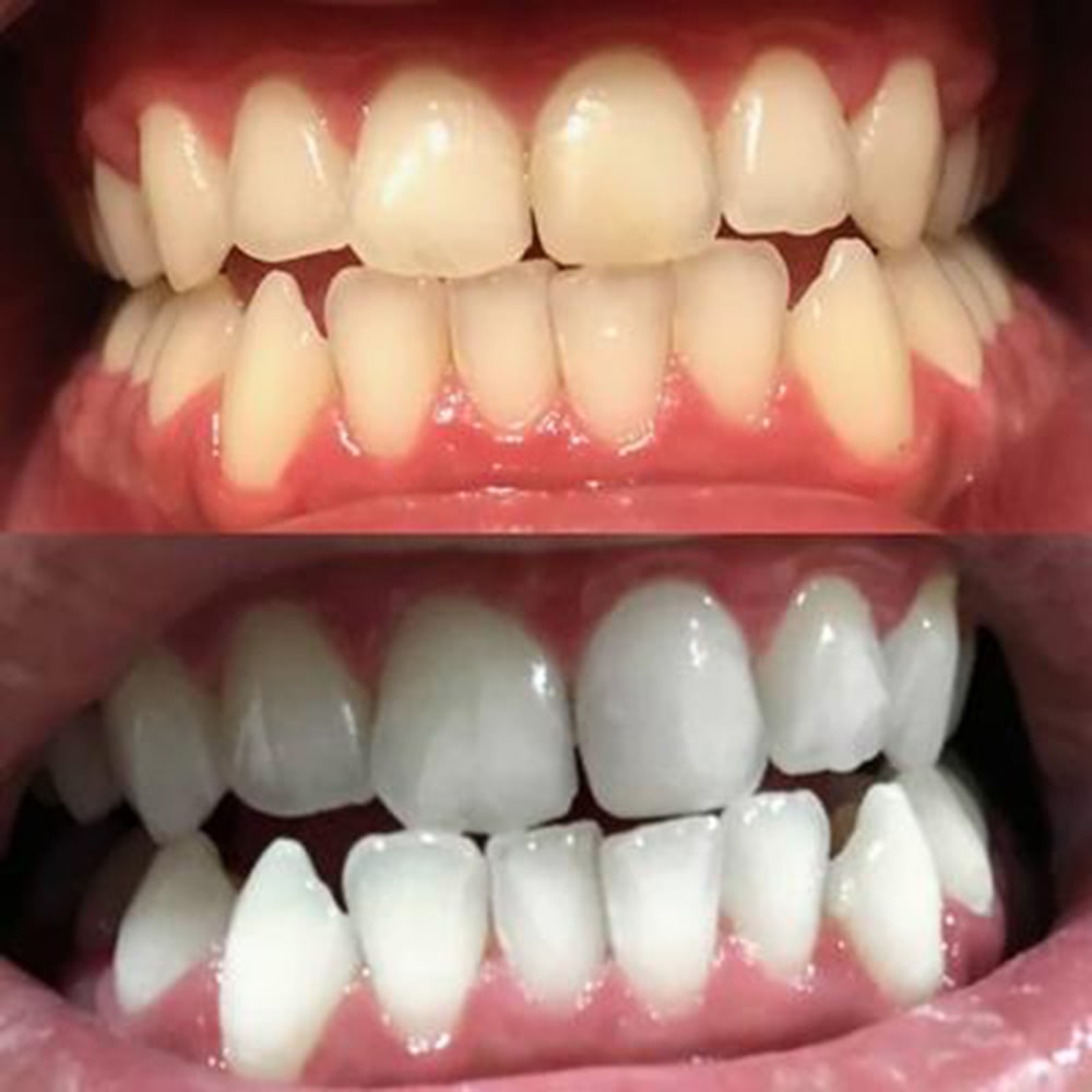 diamondsmile-zahnbleaching-schaum-zur-zahnaufhellung-zu-hause image 6