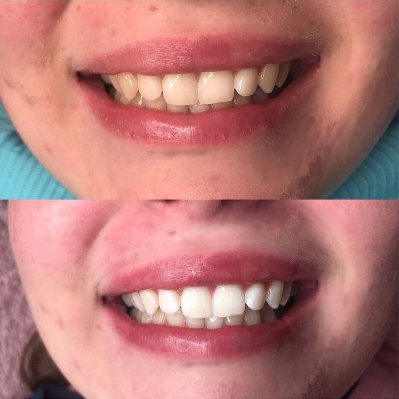 diamondsmile-pap-zahnbleaching-set-mit-gel image 6