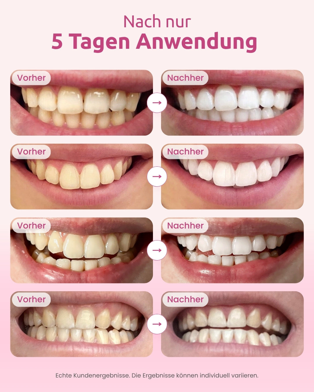 onlysmile-zahnaufhellungsset-led-sichtbar-wei-ere-z-hne-in-5-tagen image 4