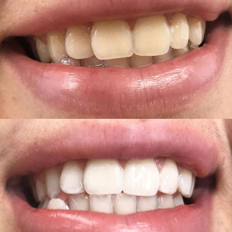 diamondsmile-pap-zahnbleaching-set-mit-gel image 5