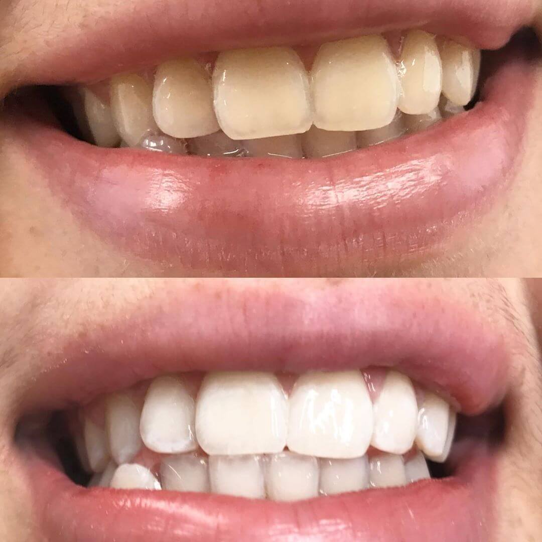 diamondsmile-power-zahnbleaching-set-mit-farbkorrektur-serum image 5